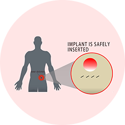 STEP 3: ADDTREX implant insertion